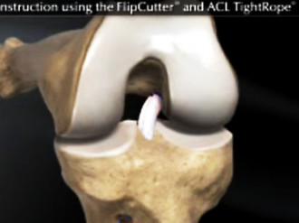 reconstrução do lca com tendões flexores